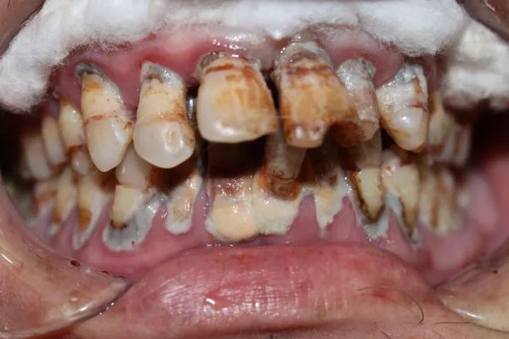 牙医遇见最烂的牙齿到底有多烂