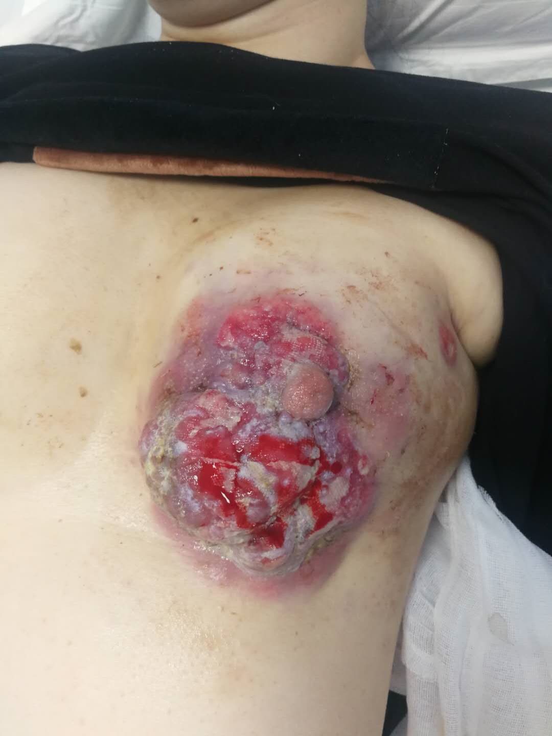 乳房切除后的样子伤口图片