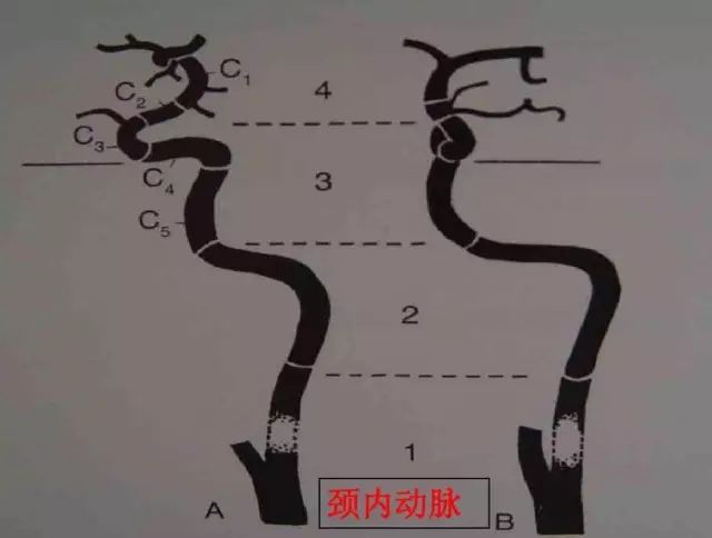 十分鐘,教你輕鬆看懂腦血管造影_網絡