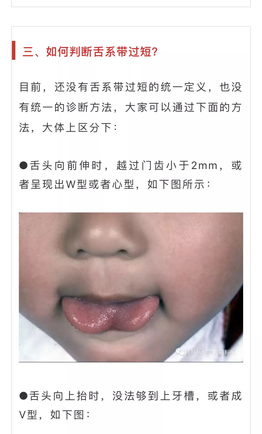 宝宝舌线过长图片图片