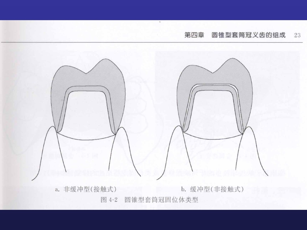 迪白口腔朱宏傑告訴你:什麼叫套筒冠義齒?