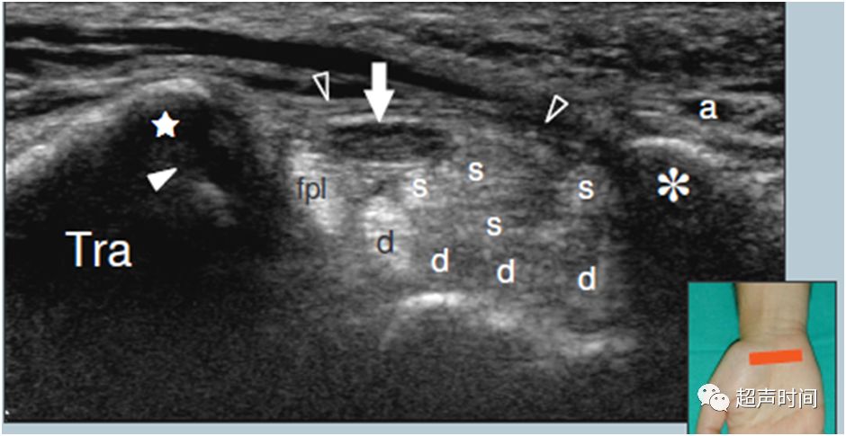 超声典型病例腱鞘炎导致腕管综合征