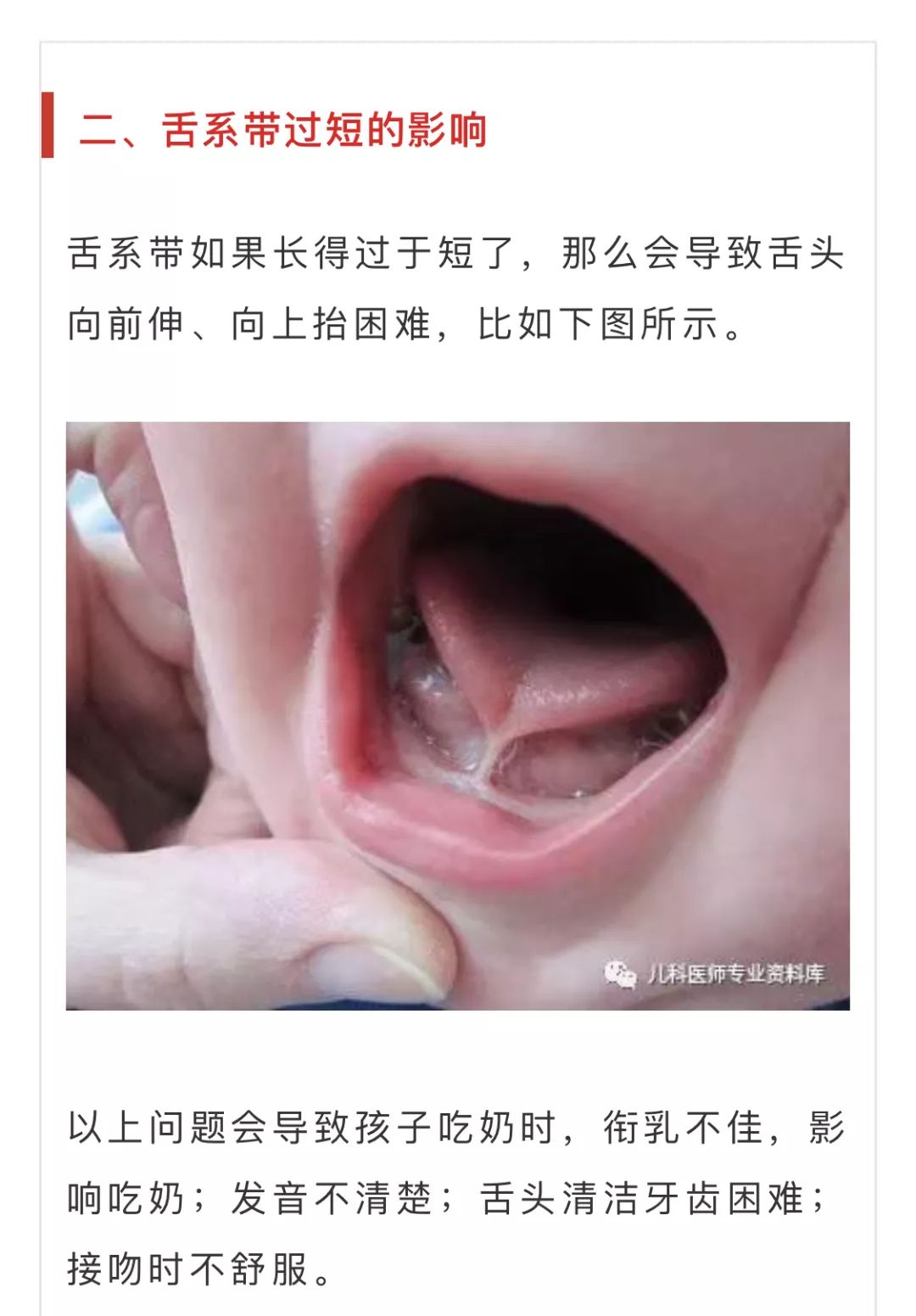 舌系带连着牙龈图片图片