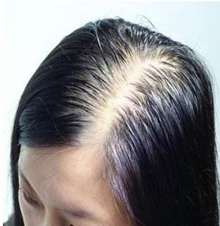 易智美:脂溢性脱发的发病原因和改善方法