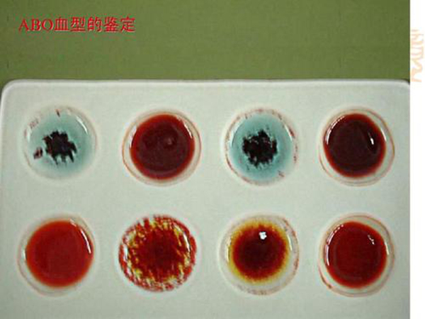 血型鉴定凝集反应图片图片
