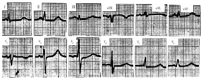 低血钙心电图图片