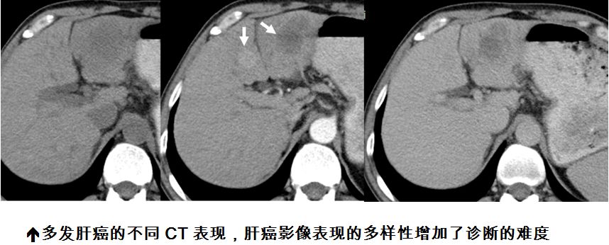 对于肝硬化结节(包括再生结节与不典型增生结节)的显示优于超声与ct