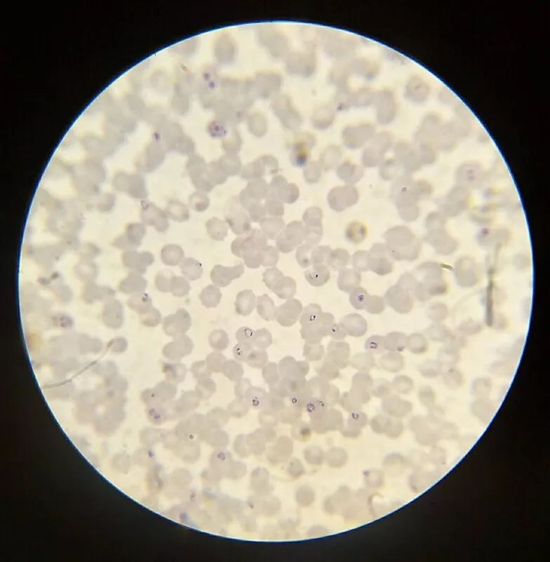 显微镜下技能高,恶性疟疾露原形
