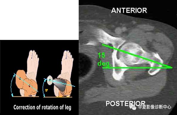 正常為12°~15°股骨頸的長軸與股骨的冠狀形成的角度前傾角 110 °髖
