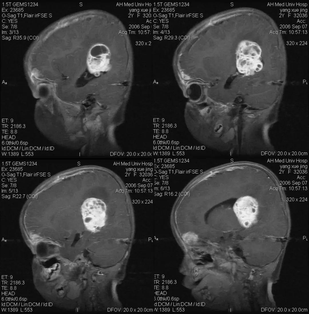 脑瘤片子图片