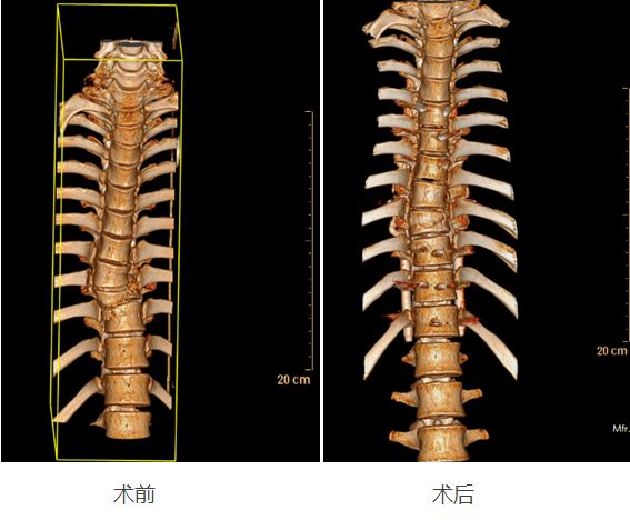 神經減壓 關節突植骨融合 胸5-7,胸10-12椎弓根釘棒系統內固定術