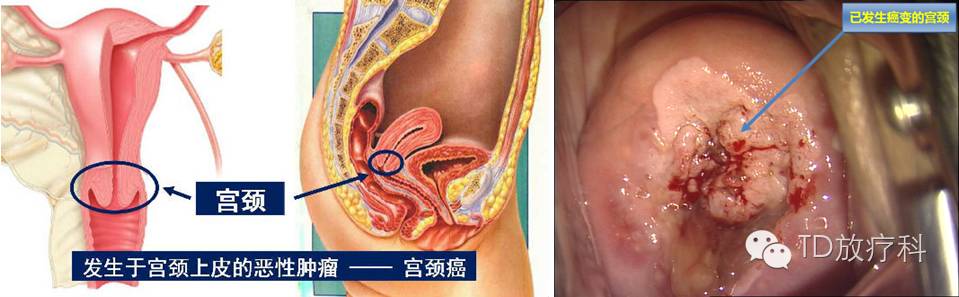 宫颈癌防治科普系列之一:什么是宫颈癌?我会得宫颈癌吗?