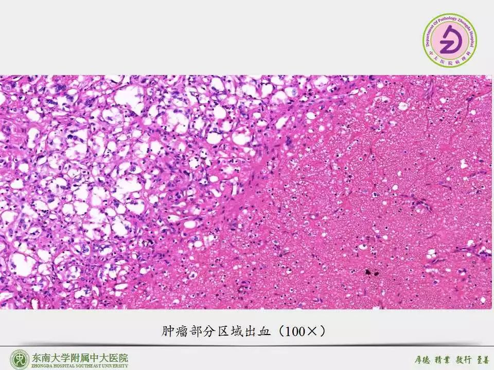 嗜铬细胞瘤(伴显著血管瘤样间质) ,副神经节瘤(伴显著血管瘤样间质)