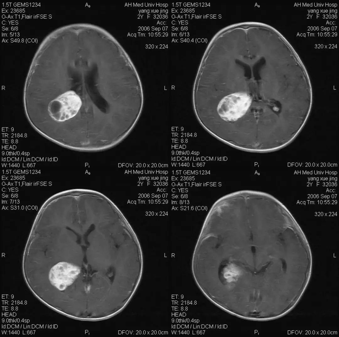 病史:女,15岁,外伤后ct检查发现颅内肿瘤2019年04月16日颅内肿瘤r