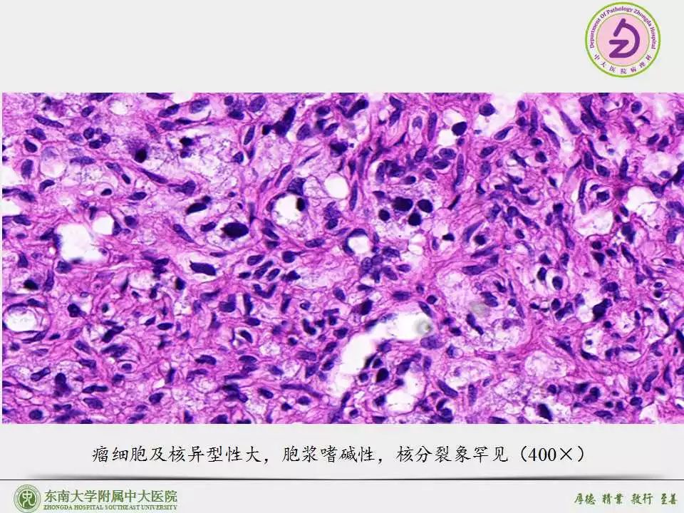 嗜铬细胞瘤伴显著血管瘤样间质副神经节瘤伴显著血管瘤样间质病例东南