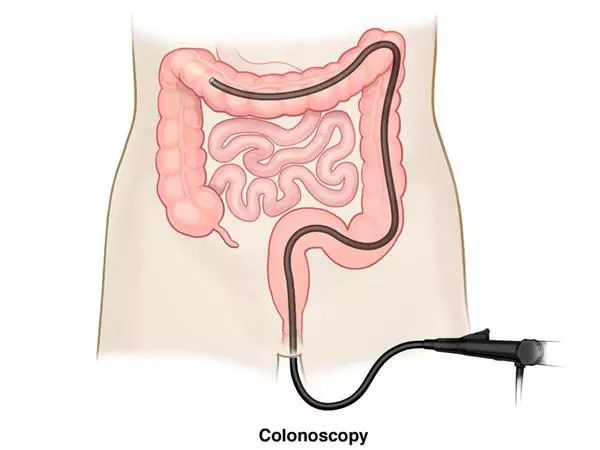 我国有一亿人需要做肠镜一组数据告诉你肠镜是怎么救命的