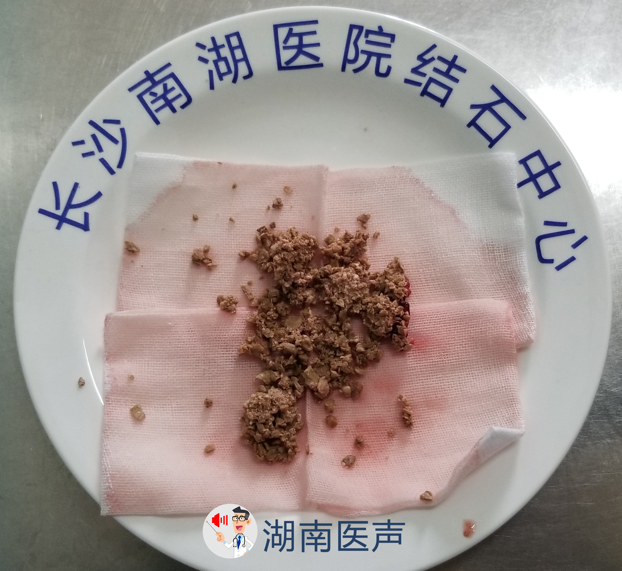 双肾泥沙样结石图片