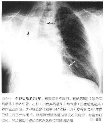 61你會注意到,心臟和氣管移位向白肺側(圖4-9).