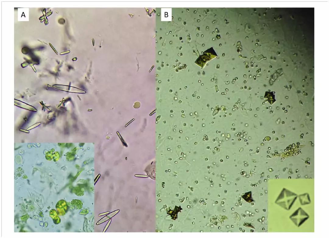 结晶并不总是代表疾病状态,健康个体中也可见到,特别是食用高草酸盐