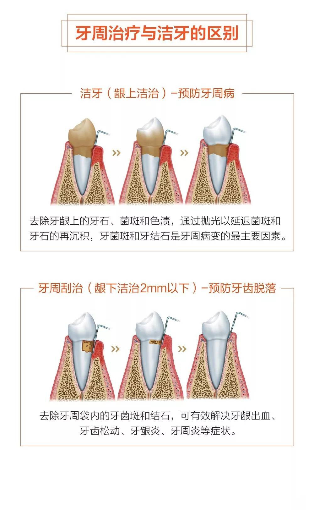 牙周病的治疗方法图片