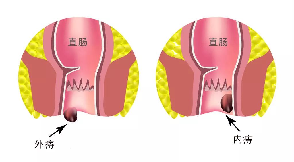 外痔动漫图片