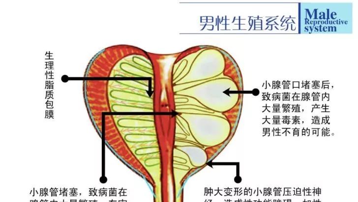 臨床症狀包括尿頻,尿急等排尿症狀,以及恥骨區域,腹股溝部等部位的