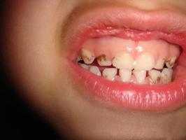 儿童牙齿钙化早期图片图片
