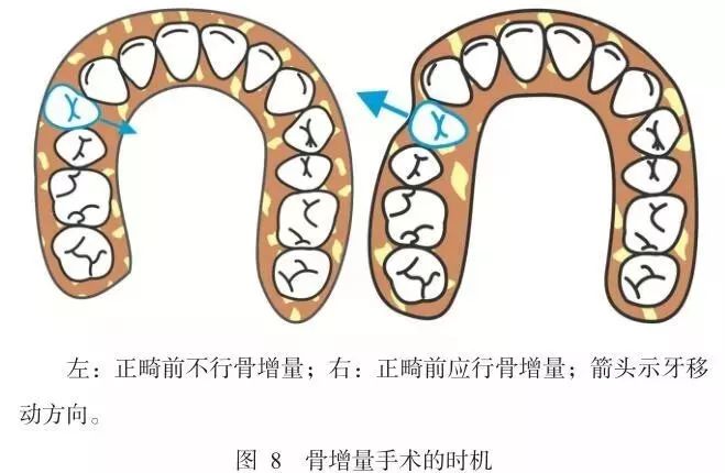 2附着龈增量手术的术式增加附着龈宽度的手术方法中,上皮下结缔组织瓣