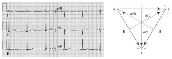 這在心電圖上就表現為Ⅰ,Ⅱ,Ⅲ導聯其中之一的心電示波近似於一直線.