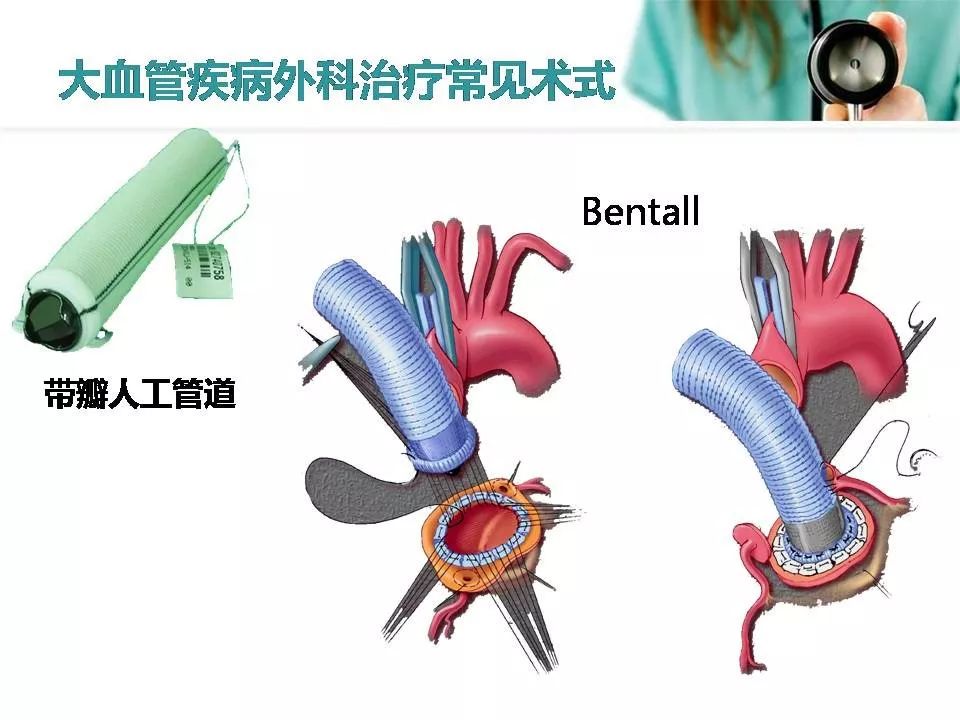 主动脉夹层手术步骤图图片