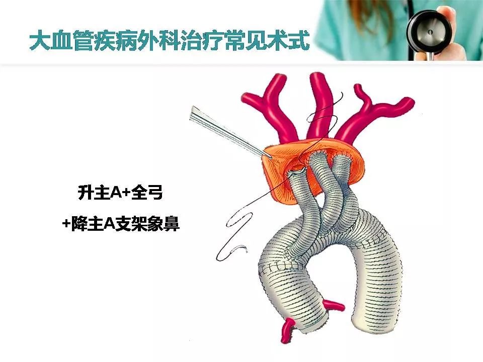 主动脉夹层手术步骤图图片