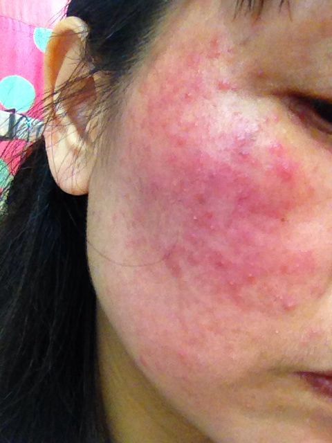 得了激素性皮炎会在脸上留疤痕吗?