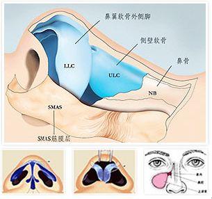 鼻中隔手术图解图片