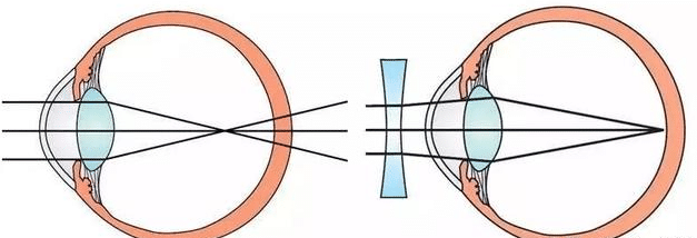 視物模糊時睫狀肌持續收縮調節,會加重眼疲勞,加速近視進展,形成一個