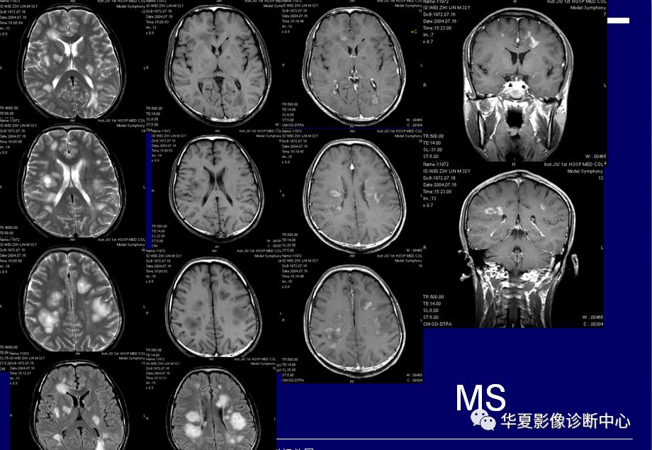 脑白质脱髓鞘病变的影像诊断
