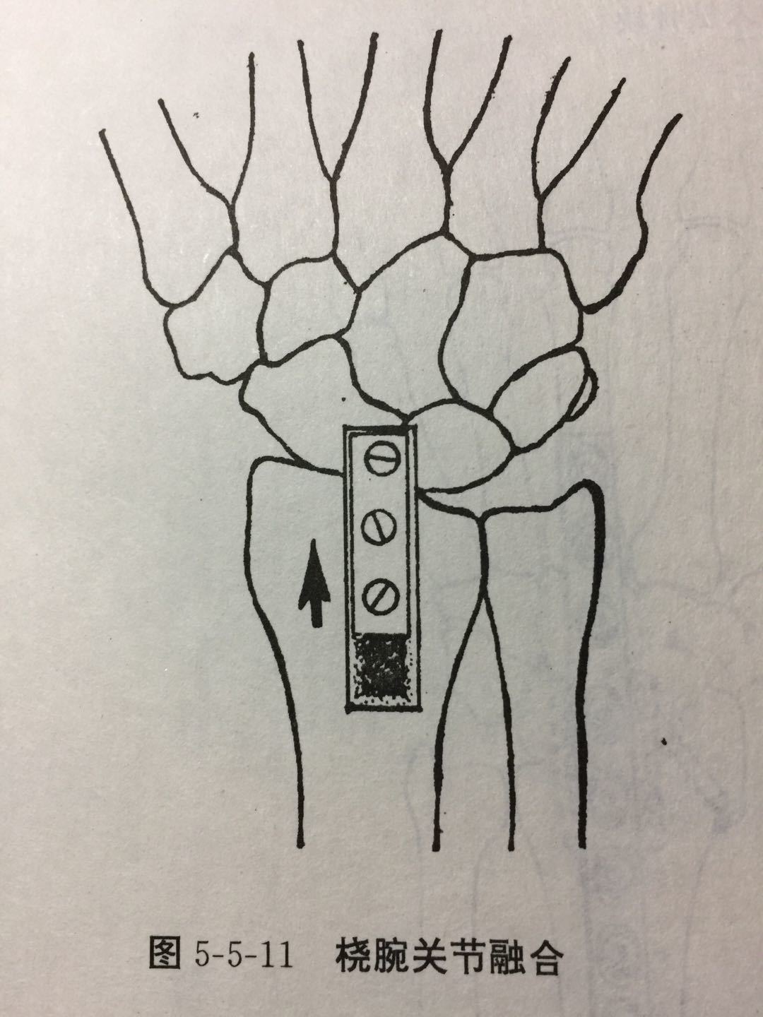 腕關節融合 (原創)_橈骨