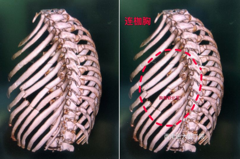 肺挫伤,左侧血胸左侧多根多处肋骨骨折家人立即将邓先生送往西南医科