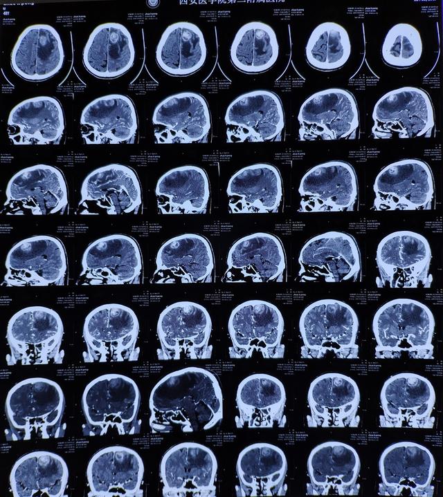 建議去做ct檢查下頭部有沒有問題,結果頭顱ct檢查顯示:左額頂葉佔位性