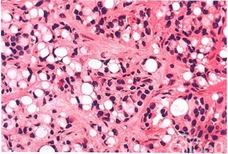 泡沫細胞狀腺體型 其特點為具泡沫狀豐富胞漿的多角形或柱狀瘤細 