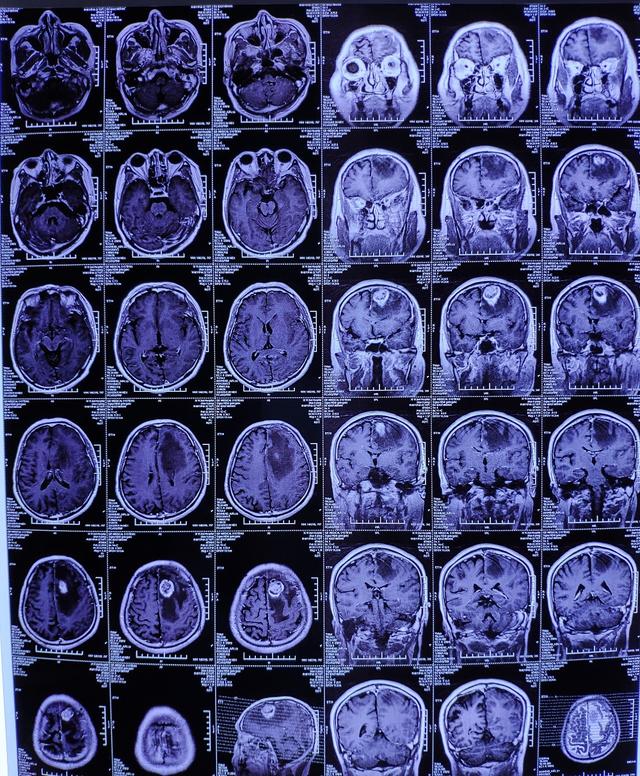 神經內科門診醫生看了趙先生的情況,建議去做ct檢查下頭部有沒有問題