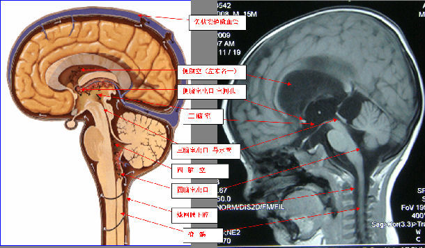 脑积水的诊断与治疗 (原创)