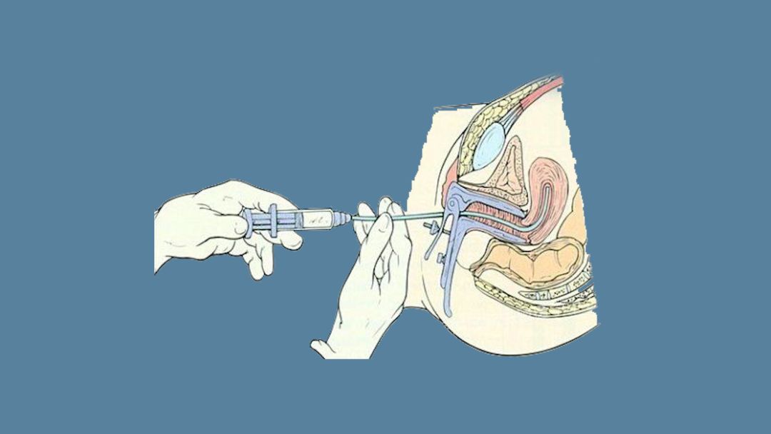 试管婴儿有多种实现方法,有采取人工授精的,人工取卵的还有胚胎移植的