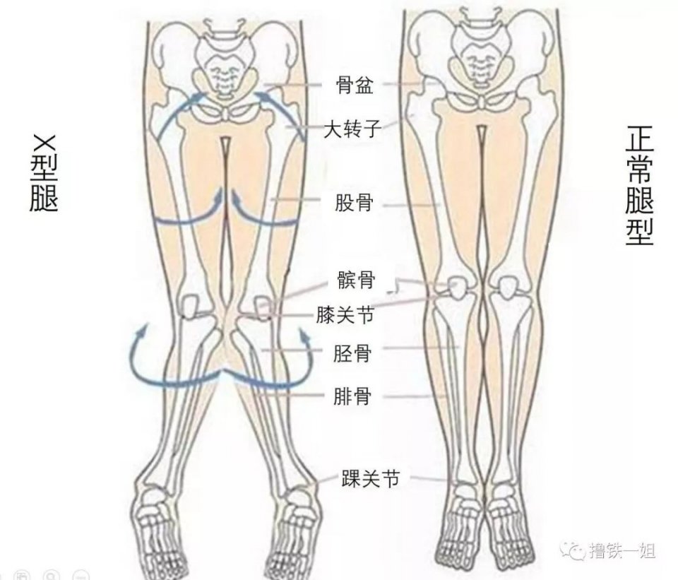 过了,x型腿与正常腿型不一样的地方有3处:髋部内旋,股骨内旋,胫骨外旋