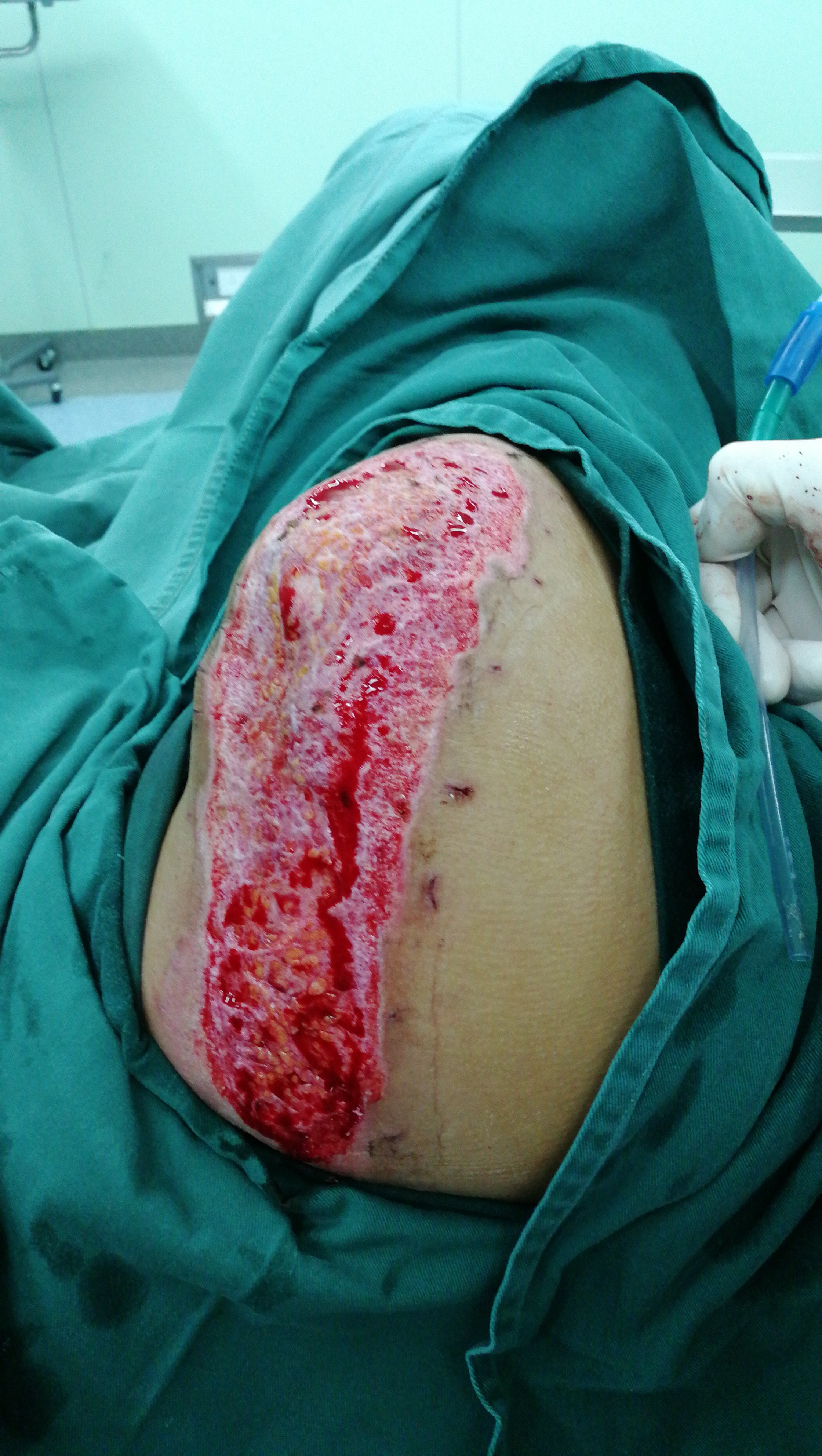受伤后第三天受伤当日下面这个患者右肩部被机器皮带绞伤,大片组织