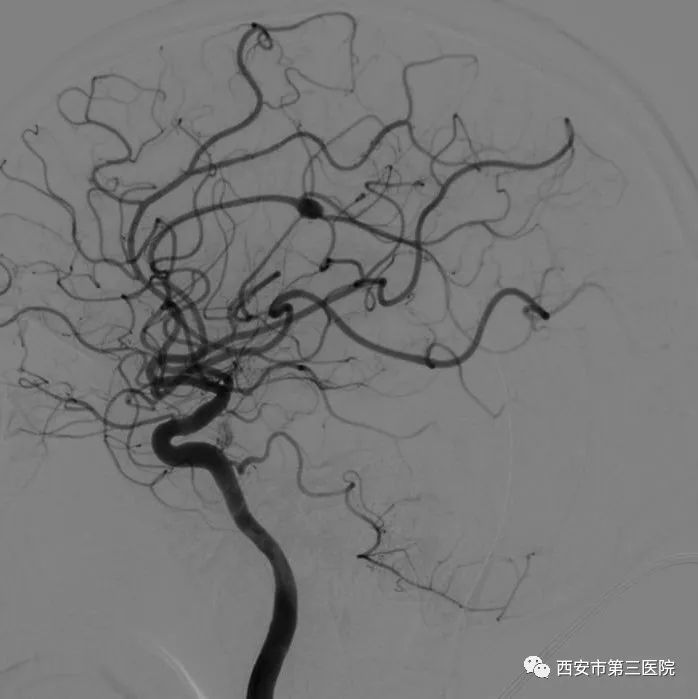 大脑动脉血管三维图图片