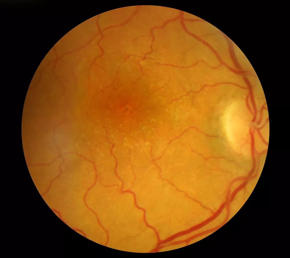 黄斑出血和黄斑变性在视网膜脱离中,70%是近视眼,这是最常见的高度