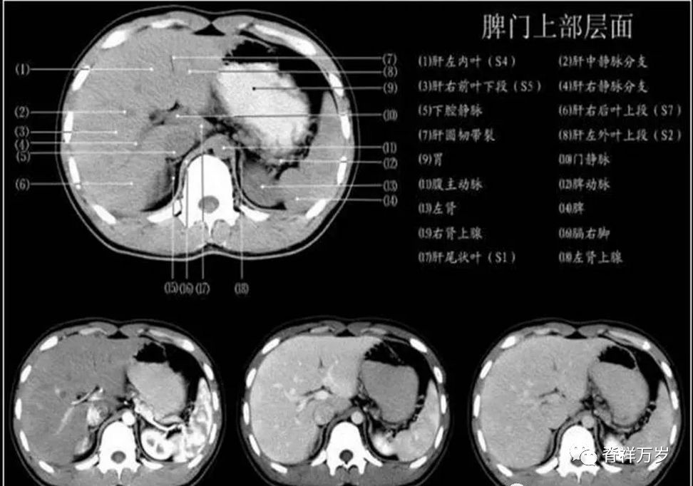 脾动脉CT解剖图图片