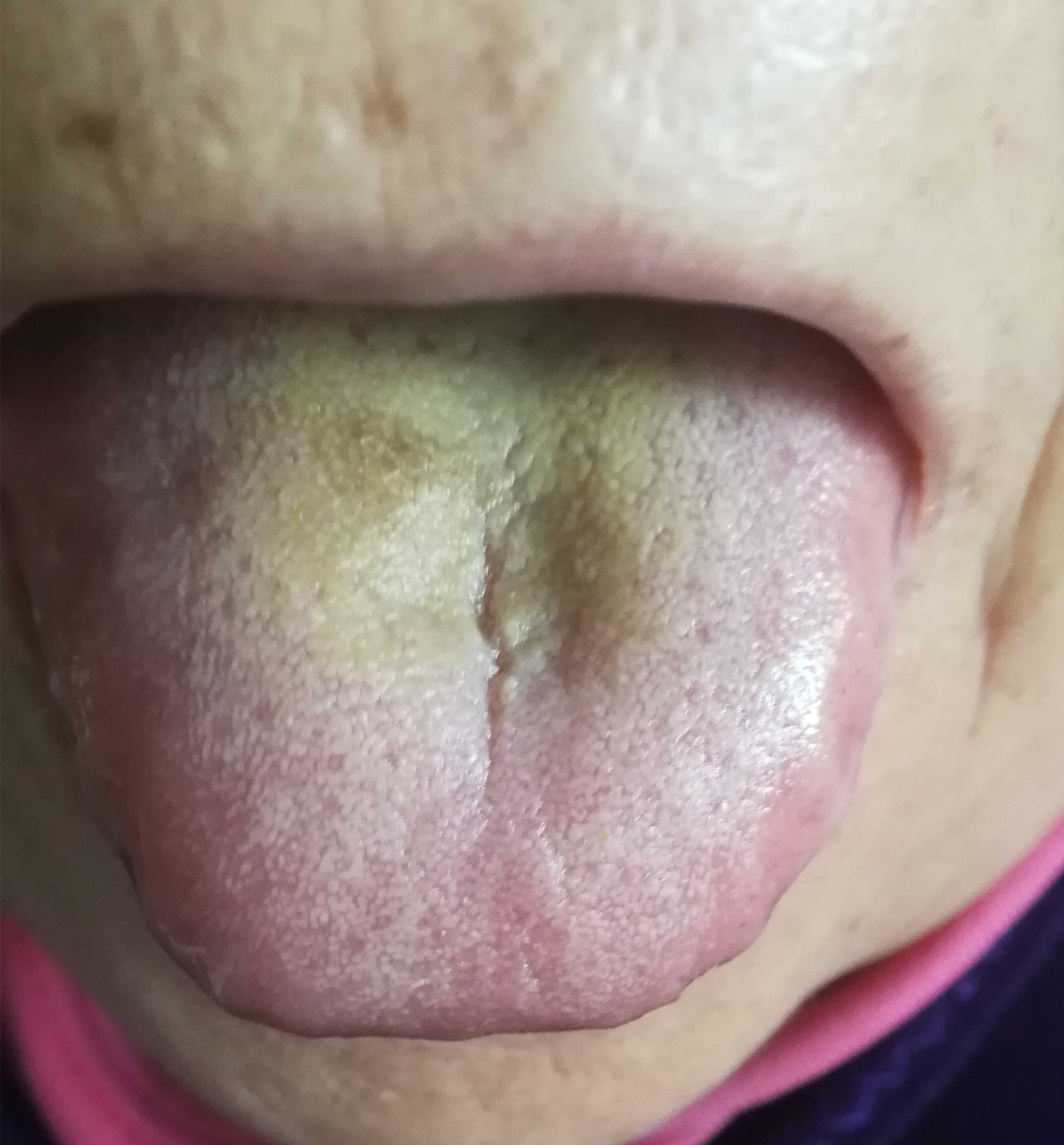 舌头中间有条沟图片图片