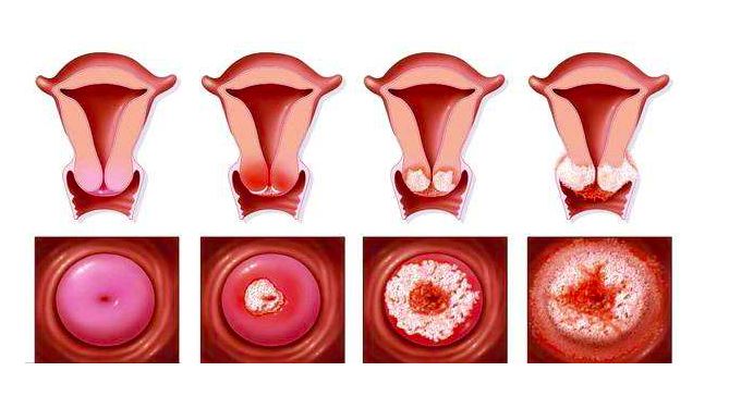 宫颈癌的外观图片图片