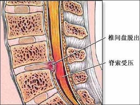 椎間盤突出壓迫周圍組織神經示意圖